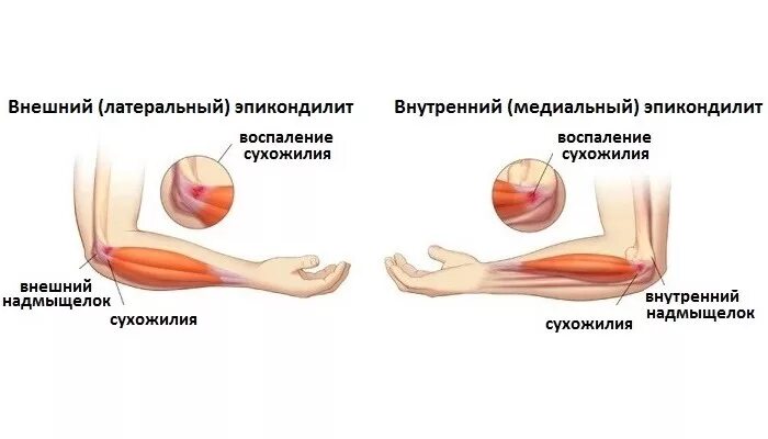 Болят локти причина и лечение у женщин. Медиальный эпикондилит гимнастика. Эпикондилит локтевого сустава. Латеральный эпикондилит локтевого. Латеральный эпикондилит сухожилие.