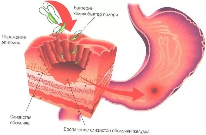 Слизистая желудка выделяет. Язвенная болезнь желудка и 12-перстной кишки. Гастрит.. Рубцово-язвенная деформация ДПК. Поверхностный гастрит. Бульбит желудка. Бульбит деформированной луковицы ДПК.