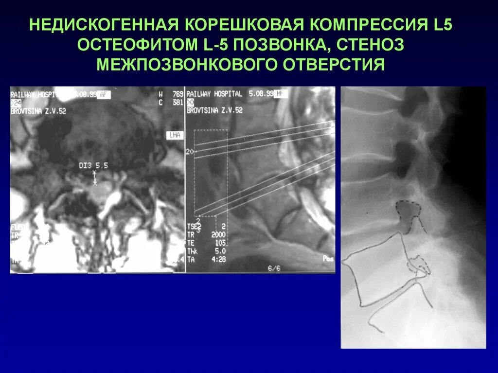 Корешковое отверстие. Стеноз позвоночного канала l2-l3. Абсолютный стеноз позвоночного канала l3-l4. Абсолютный стеноз позвоночного канала l3-l4. Спинной мозг внутри позвоночника.