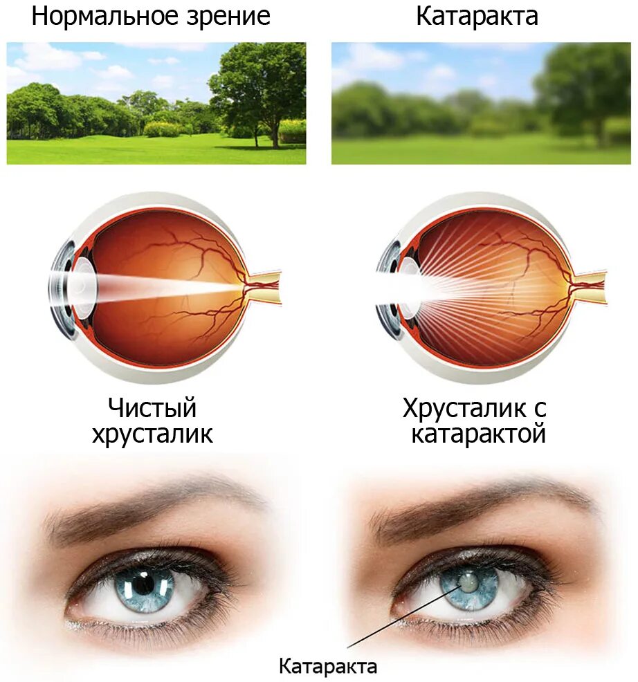 Факосклероз глаз что это такое. Хрусталик глаза. катаракта помутнение хрусталика.