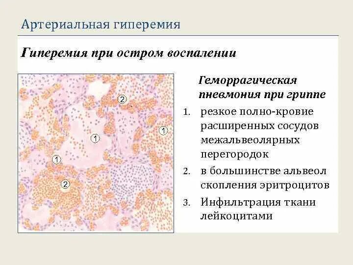 Артериальная гиперемия воспаление. Серозно геморрагическая пневмония. Артериальная гиперемия. Артериальная гиперемия (полнокровие). Воспалительная артериальная гиперемия.