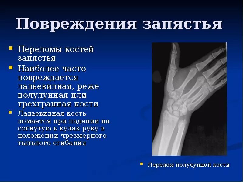 Симптомы перелома или трещины. Лучезапястный сустав лучевая кость перелом запястья. Перелом лучевидной кости запястья. Перелом Луче зспястного сустсва. Перелом кости лучезапястного сустава.