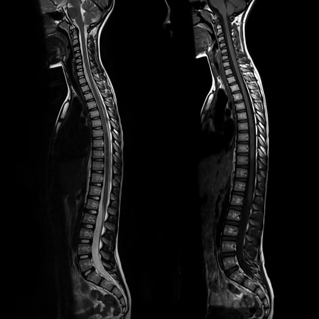 Мрт спинного отдела. Мрт спинного мозга грудной отдел. Рентген кт мрт позвоночника. Мрт спинного мозга грудного отдела позвоночника. Мрт спинного мозга норма.
