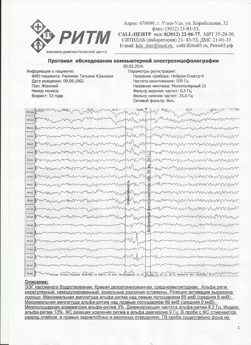 Альфа ритм ЭЭГ. ЗЧМТ СГМ. Реакция усвоения ритма на ЭЭГ. Максимальная амплитуда Альфа ритма над левым полушарием норма.