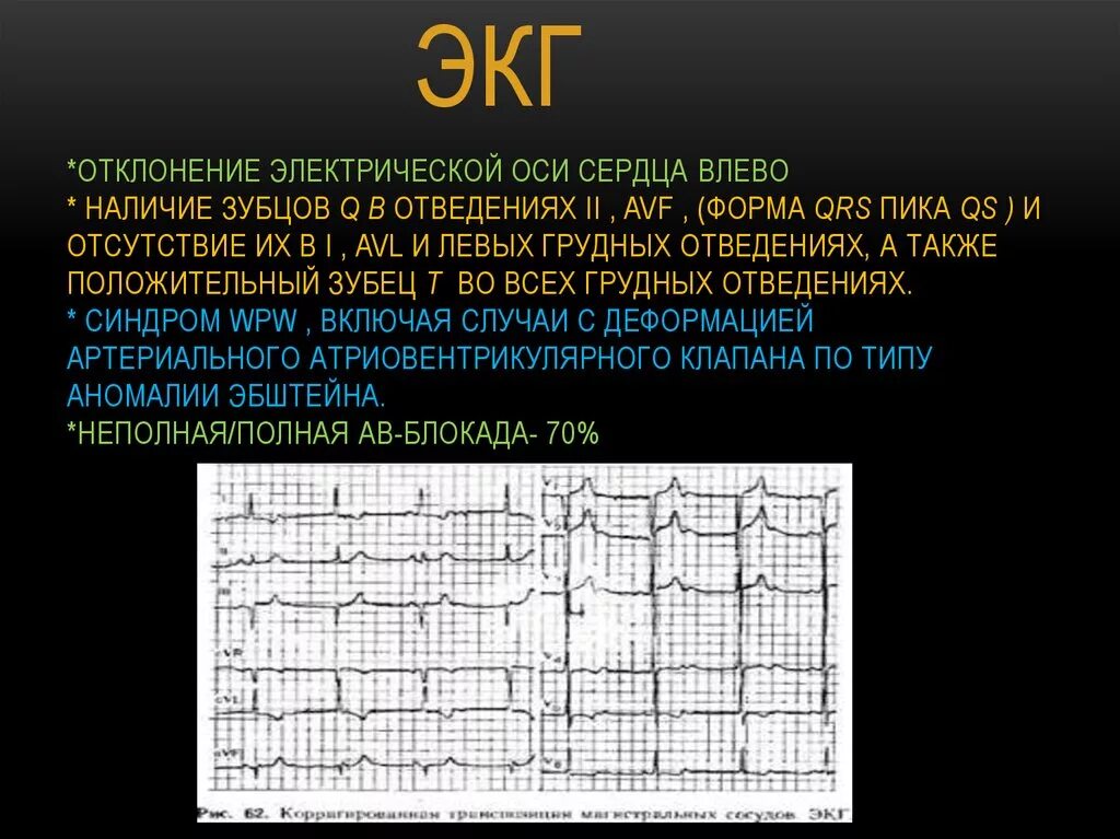 Экг отклонение влево у взрослого что это