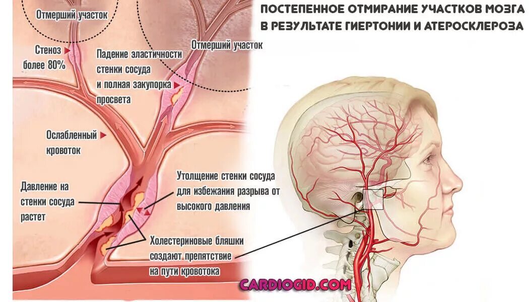 что расширяет сосуды головного