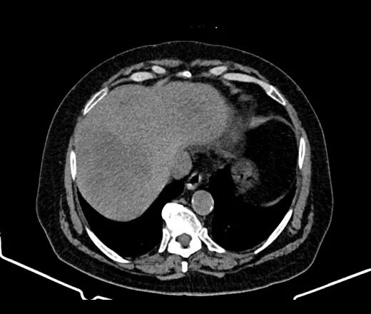 Гиповаскулярное образование в печени. Гиповаскулярные образования печени на кт. Гиповаскулярный МТС В печени. Гиповаскулярные образования почек кт. МТС В печень, брюшину.