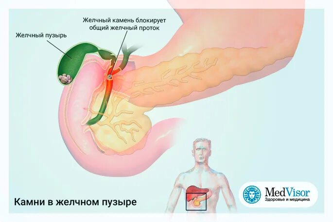 Желчный пузырь застой отзывы