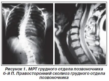 Кт сколиоз