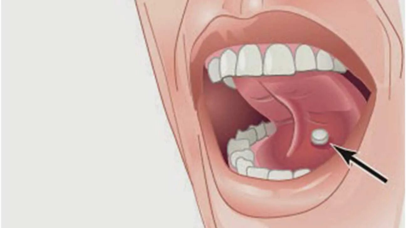 Боль во рту после еды. Киста подъязычной слюнной. Воспаление подъязычной. Подъязычная киста ранула.
