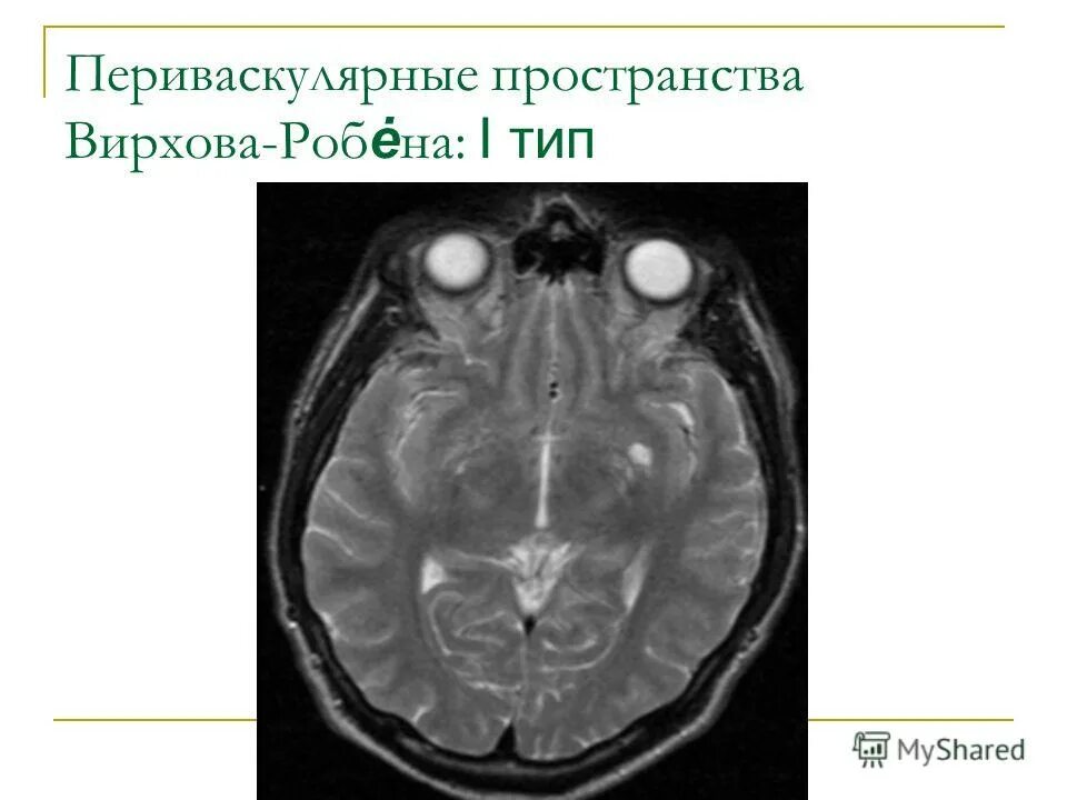 Периваскулярные пространства вирхова-робина мрт головного мозга. Расширение периваскулярных пространств головного мозга кт. Расширение периваскулярных пространств мрт. Что значит пространства вирхова робина. Что значит пространства вирхова робина.