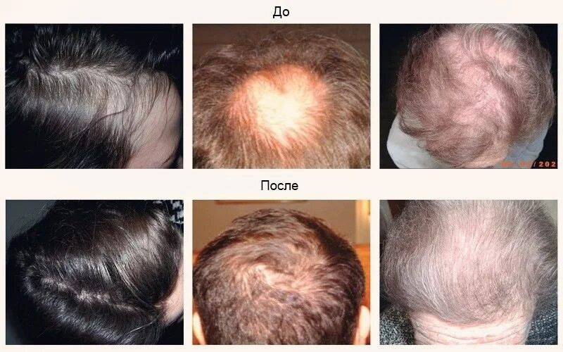 После химии выпадают. Мезотерапия волосистой части головы. Мезотерапия волосистой части головы до и после. Мезотерапия волос до и после. Эффект от мезотерапии волос.