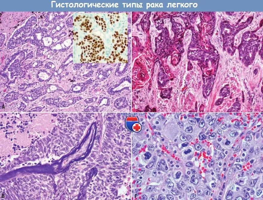 Аденосквамозный карцинома матки гистология. Плоскоклкточный раклегкого гистология. Синоназальная карцинома гистология. Стадии рака легких плоскоклеточный