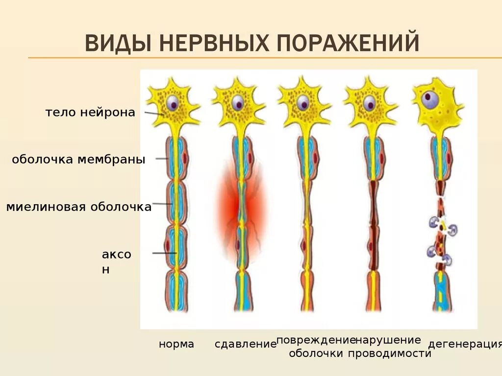 Тип поражения аксональный. Регенерация периферического нерва. Регенерация нервного волокна схема. Дегенерация нервных волокон. Восстановление нервных волокон.