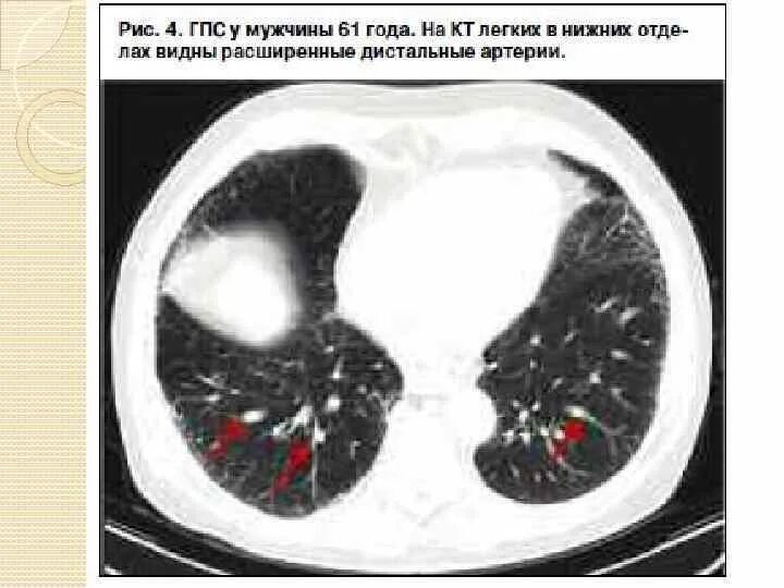 Цирроз на кт. Гепатопульмональный синдром на кт. гепатопульмональный синдром при циррозе. гепатопульмональный синдром патогенез. гепатопульмональный синдром этиология.