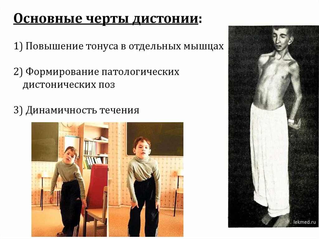 Мышечная дистония код