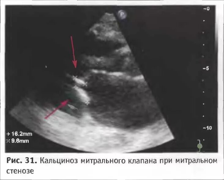 Кальциноз митрального клапана. Кальцинат створок аортального клапана. Кальциноз створок клапанов сердца. Кальцификация створок митрального клапана. Кальцинаты створок митрального клапана.