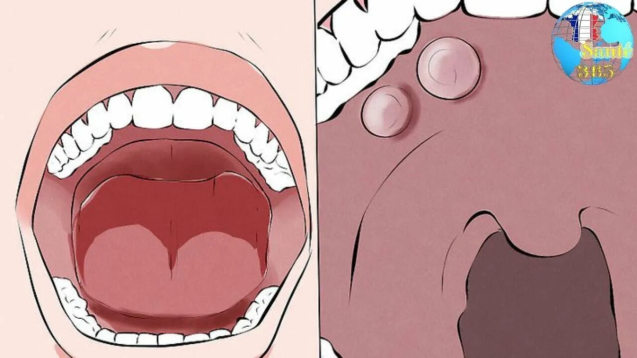 Canker Sores: MedlinePlus
