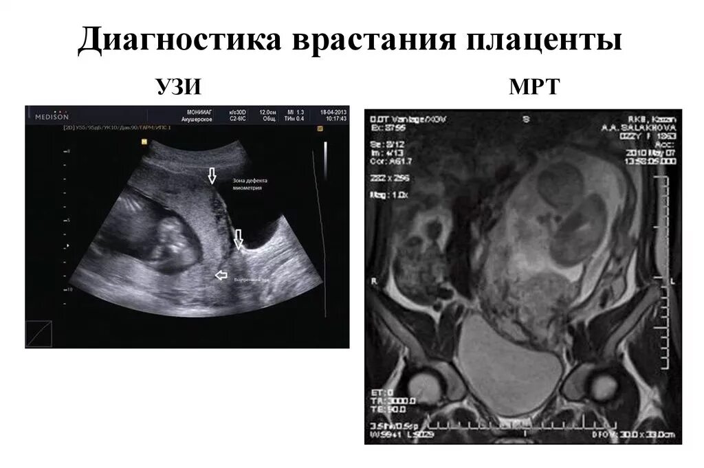 Плацента на рубце матки