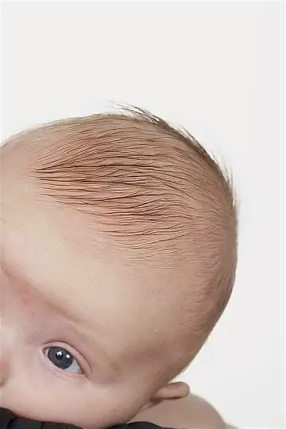 Форма головы у новорожденных.