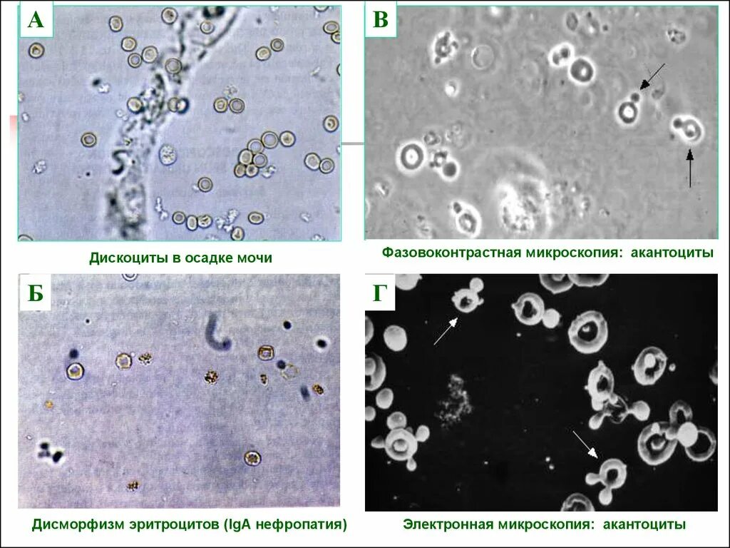 ФСВОК микроскопия осадка мочи. Фазово-контрастная микроскопия осадка мочи. Эритроциты микроскопия 1. Микроскопия осадка мочи эритроциты.