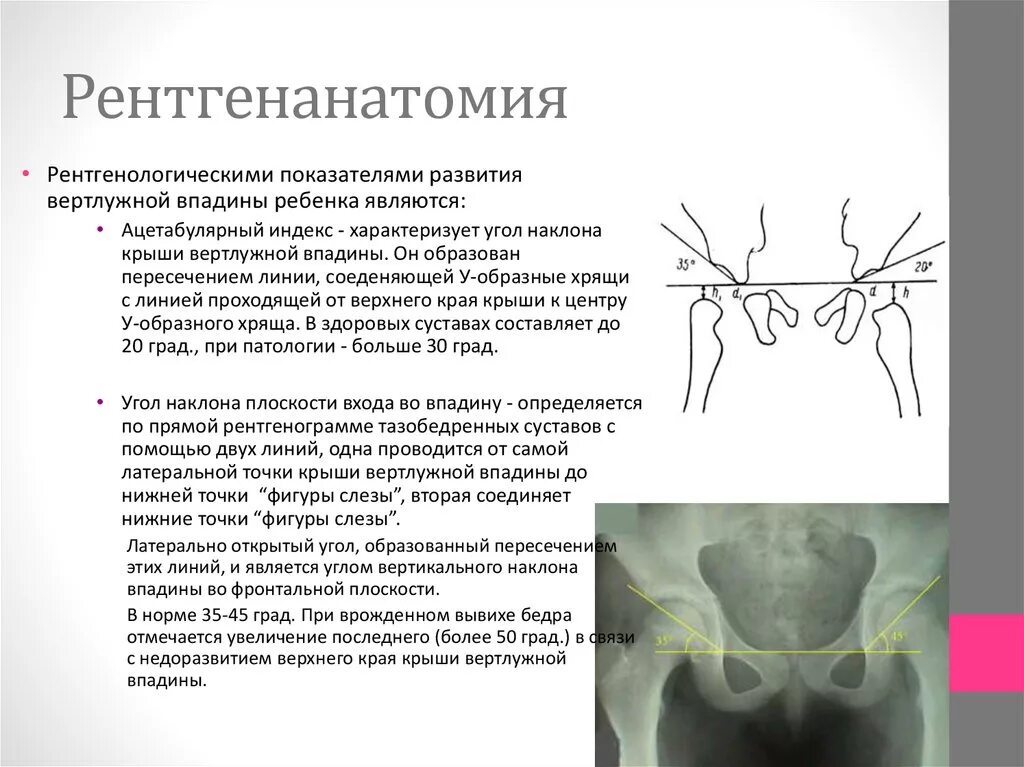 Углы суставов ребенка норма. Схема рейнберга врожденный вывих бедра. дисплазия тазобедренных суставов ацетабулярный угол норма. ацетабулярный угол рентген тазобедренных суставов. дисплазия тазобедренных суставов рентгенодиагностика описание.
