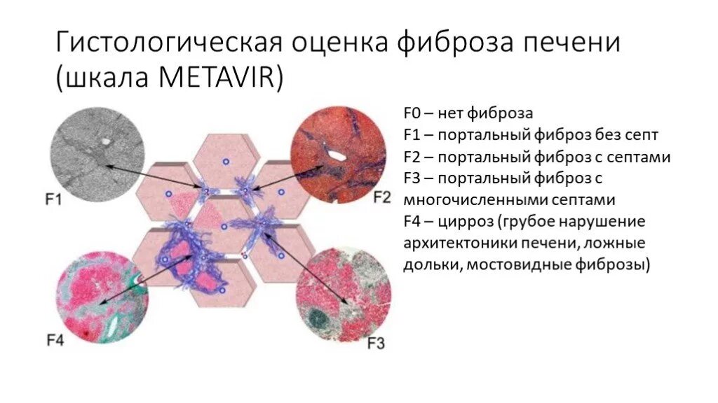 Фиброз печени f1 по шкале metavir. Степень фиброза по шкале метавир. Стадии развития фиброза печени. Фиброз печени f3 по шкале метавир. Фиброз печени 2 степени лечение