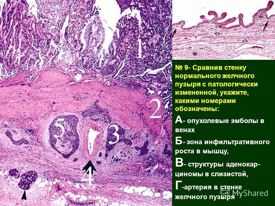 G1 опухоли. Опухолевые эмболы гистология. Опухолевые эмболы в сосудах. Раковые эмболы гистология.