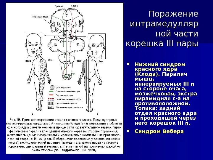 Левосторонний гемипарез очаг поражения. Альтернирующий синдром Вебера. Синдром левостороннего гемипареза. Синдром Вебера при поражении среднего мозга. Левый гемипарез