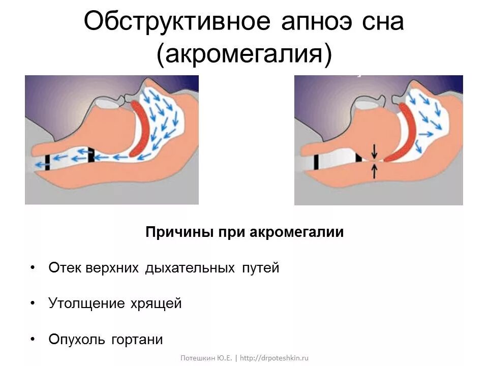 Заболевание апноэ во сне. Апноэ во сне причины. Обструктивное апноэ. Синдром ночного апноэ.