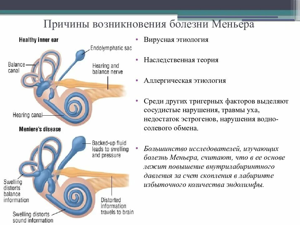 Слуховая и вестибулярная системы, синдромология. Синдром Меньера.. Болезни внутреннего уха Меньера. ДППГ И болезнь Меньера. Болезнь Меньера гидропс. Синдром миньера что это