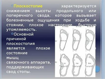 Продольное плоскостопие это