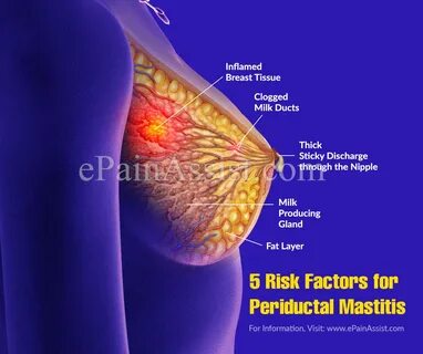 Periductal mastitis (PDM) is also a type of duct ectasia, the milk ducts un...