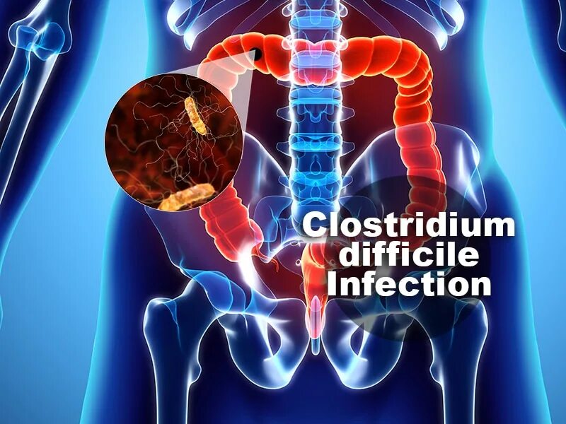 Est difficile. Clostridium difficile эндоскопия.