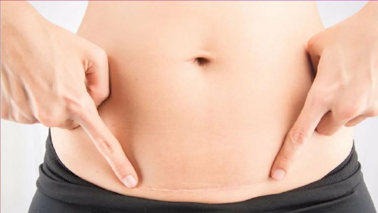 5 Tratamentos para tirar Cicatriz Antiga Quelóide, Removedor de cicatrizes, Crem