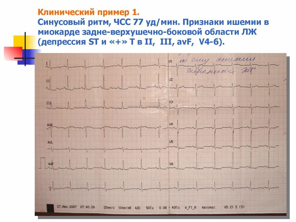 Болезни на экг. ЭКГ при хронической ишемической болезни сердца. Ишемическая болезнь сердца на ЭКГ расшифровка. Синусовый ритм инфаркт миокарда. Изменения на ЭКГ при ишемической болезни сердца.