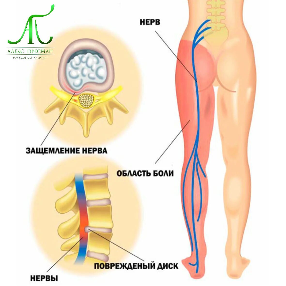 Сидальческий нерв лечение у мужчин. Седалищный нерв. Схема защемления седалищного нерва. Корешки седалищного нерва.