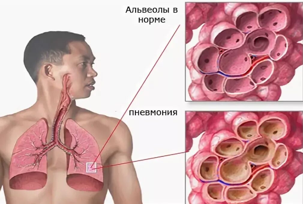 Пневмония признаки у взрослых. Пневмония. Пневмония симптомы.