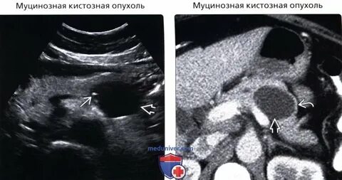 Поджелудочная железа кистозно солидное образование
