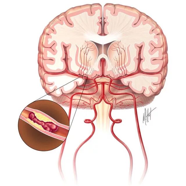 Тромбоэмболия сосудов головного мозга. Патологии артерий головного мозга. Тромбоз мозговых артерий. Церебральные сосуды головного мозга что это.