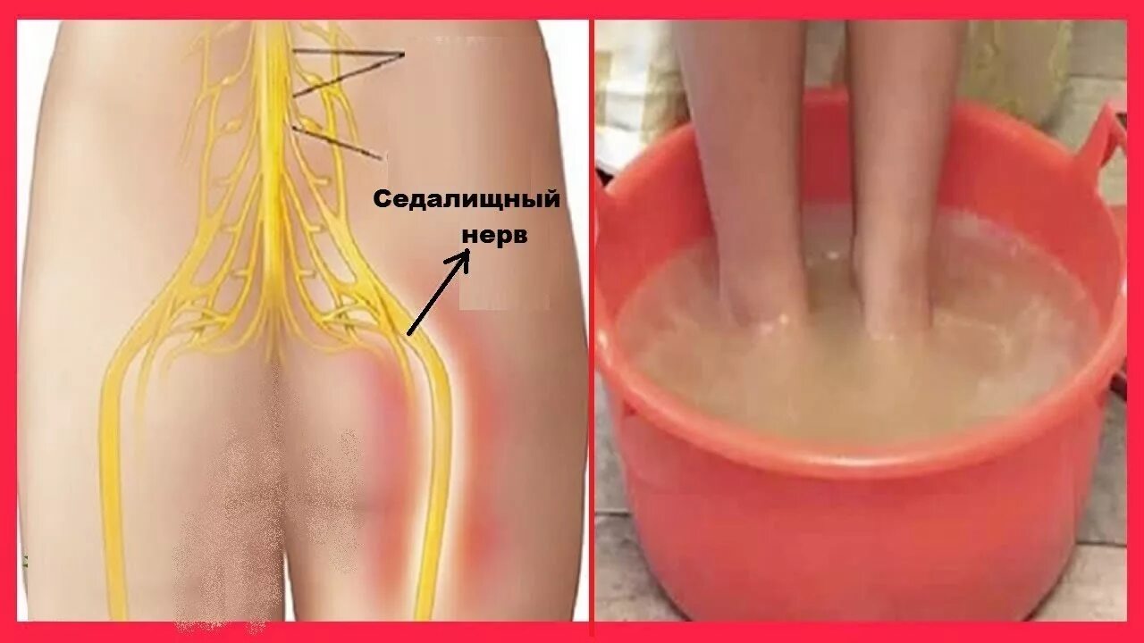 Седалищный нерв защемление симптомы у женщин лечение. Сидалеч седалищный нерв. воспаление седалищного нерва. если воспален седалищный нерв. защемление седалищного нерва.