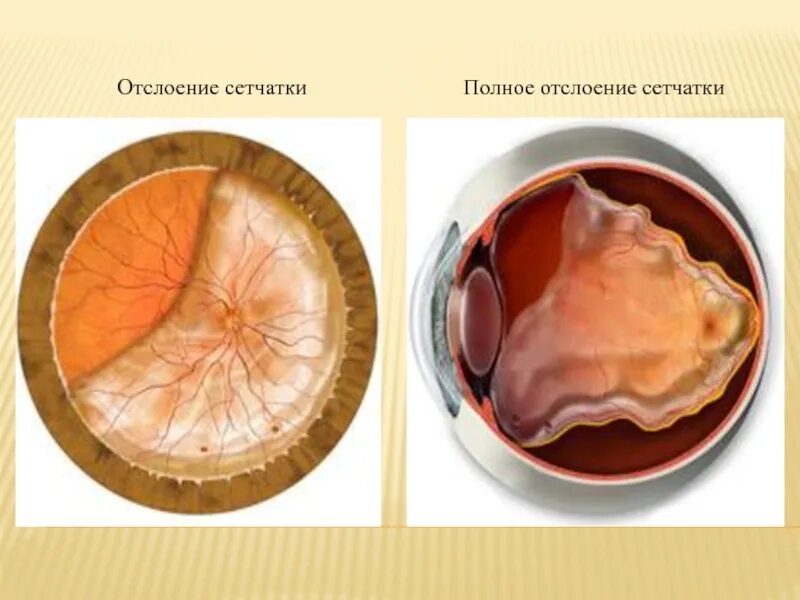 Регматогенная отслойка сетчатки глаза. Воронкообразная отслойка сетчатки. Отслойка сетчатки зрение. Пациент с отслойкой сетчатки.