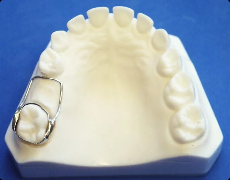 ортодонтический держатель места. держатель места для зуба. распорка кольцо ортодонти. спейс мейнтейнер. держатель места для зуба.