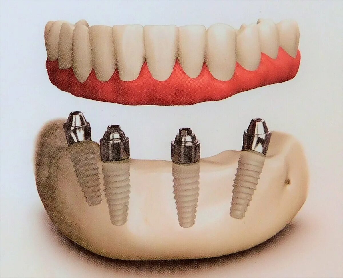 Аллон 4 протезирование. Несъемный протез на 4 имплантах.