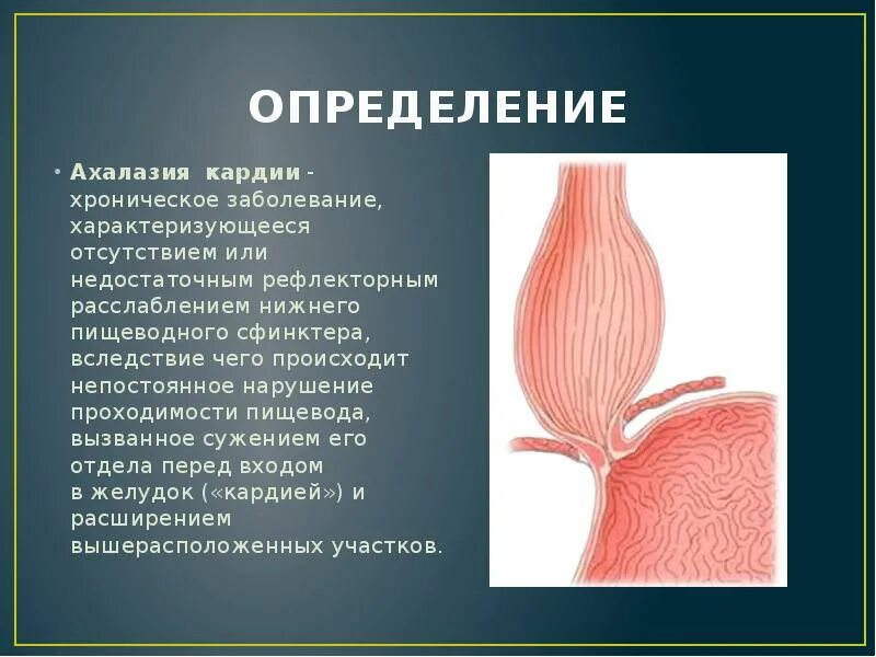 Кардия не смыкается что это значит. Кардиальный сфинктер недостаточность. Ахалазия кардии пищевода. Нижний сфинктер пищевода. Ахалазия кардиального сфинктера.