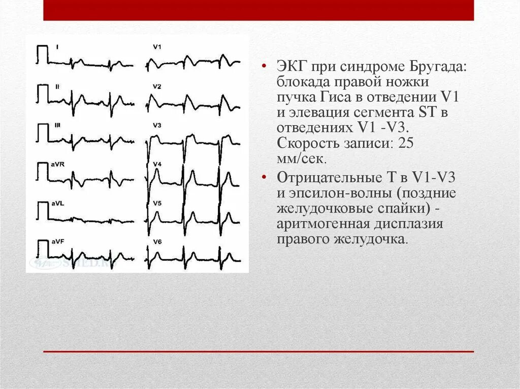 Подъем St v1 на ЭКГ. Элевация сегмента St v3-v6. St в отведениях v1-v3 в норме. V5 v6 ЭКГ стенка. Отведение v1 на экг