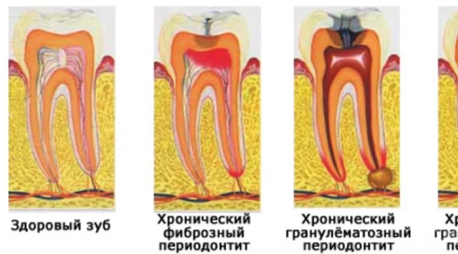 Фиброзный периодонтит