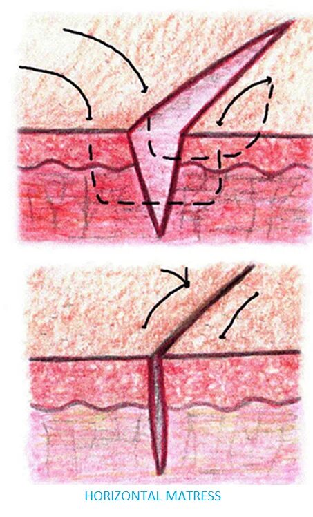 Шов матрасный хирургический. Горизонтальный и вертикальный шов по Донати. Внутрикожный Узловой шов заживление. П образный шов. Как называется шов после операции