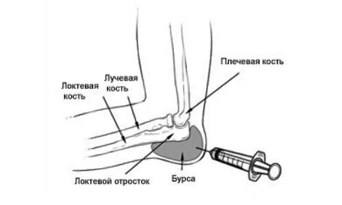 Эффективное лечение бурсита локтевого. Бурмит отростка локтевого. Бурсит локтевого отростка. Пункция локтевого сустава. Бурсит синовиальной сумки локтевого отростка.