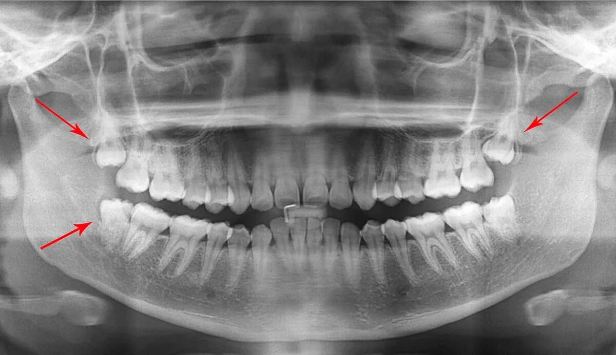 Почему зубы мудрости так называются. Расположение зубов мудрости.